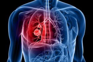 081715_cancer.pulmon_principal