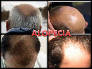 Alopecia-Portada
