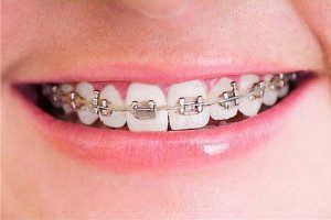 1384343055_seguro-medico-para-ortodoncia